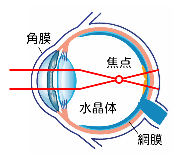 近視のイメージ図